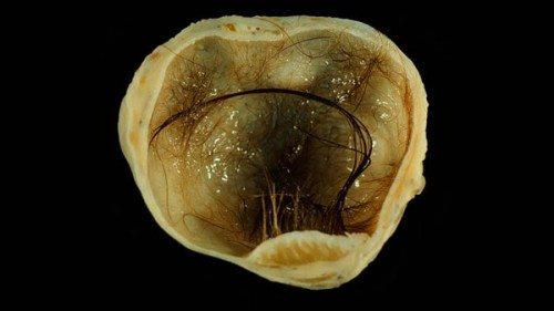 Indian American doctoral student Yamini Karanam almost killed by her embryonic twin