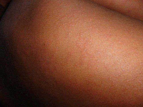 First death from measles recorded in 12 years in the US